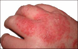 Eczema