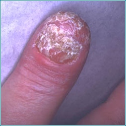 Psoriasis