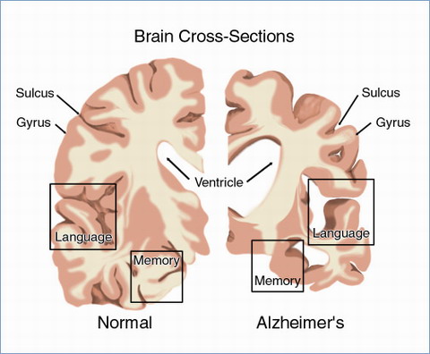 Alzheimer’s
