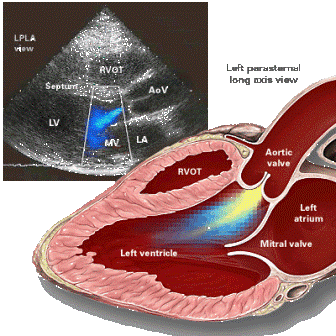 Aortic Regurgitation