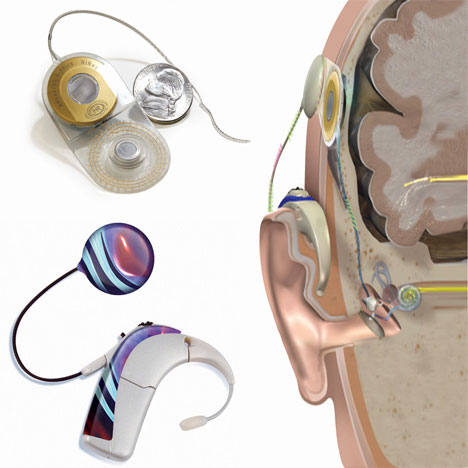 Bionic Ear