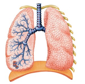 COPD