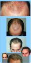 hairloss treatments