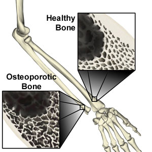 Osteoporosis