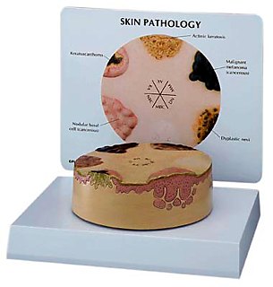 Skin Cancer