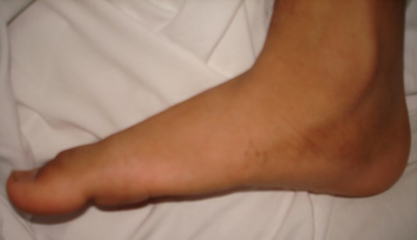 Flat Foot