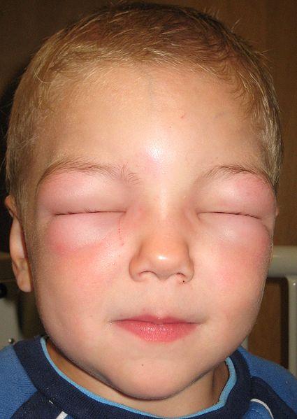 Rash and Swollen Eyelids - Treato