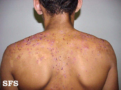 Pimply rash on buttocks/thighs - Dermatology - MedHelp