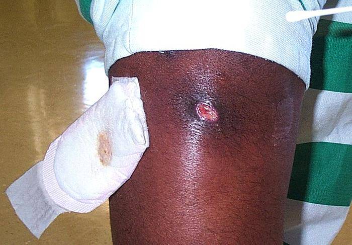  skin infection pictures, 