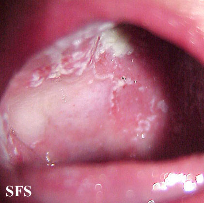 Candidiasis In Mouth 39