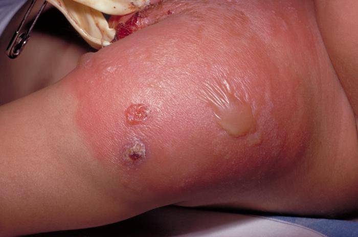 pictures of deadly strep infections