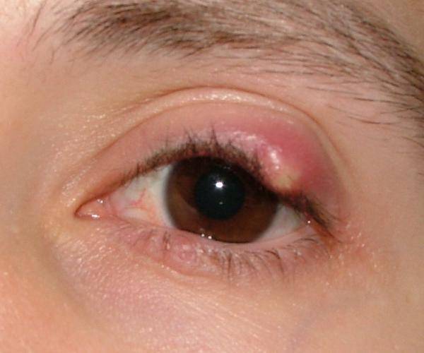 eye rashes on eyelids #11