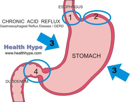 heartburn reflux acid sleeping gerd diagram chronic problems reasons avoid healthy snoring reviews remedies symptoms sleep healthhype anti part mouthpieces