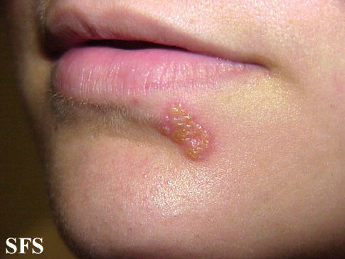 Cold Sores Pictures Chin | Top 10 Herpes Cure