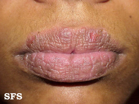 eczema around the mouth treatment - MedHelp