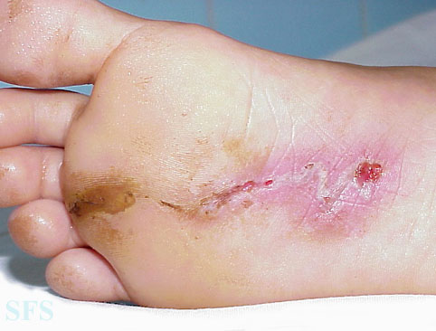 rashes on soles of feet