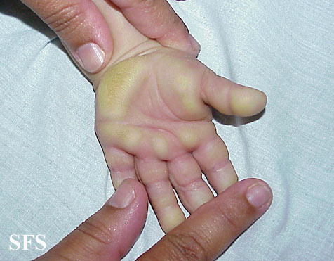 What causes itchy hands and feet? | Reference.com
