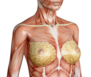 Causes of Small Breasts Genetic Causes Breast hypoplasia which is the