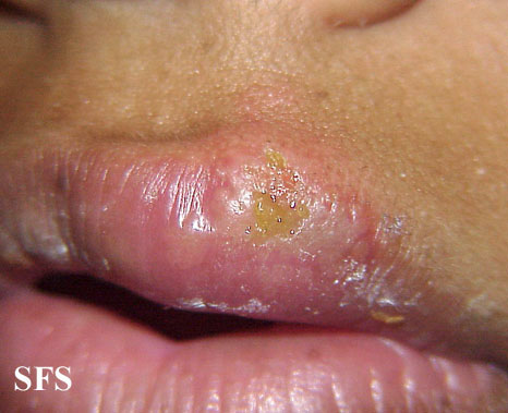 herpes sores on tongue. Herpes facialis (herpes of the