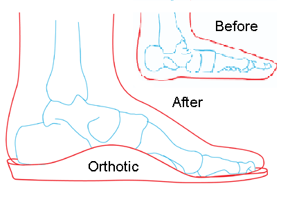 flat-foot-orthotics.gif