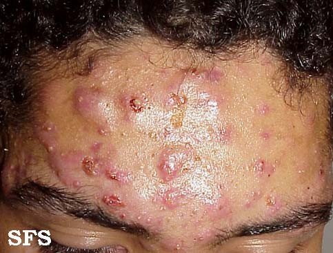 Side effects of steroid cream for psoriasis