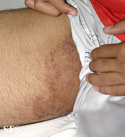 Herpes in butt crack - Doctor answers on HealthcareMagic