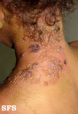 Herpes zoster on the neck Picture 7. Herpes zoster – shingles affecting the