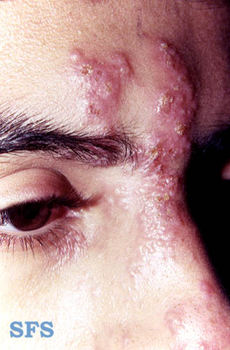 Herpes zoster on the face. Picture 1. Herpes zoster