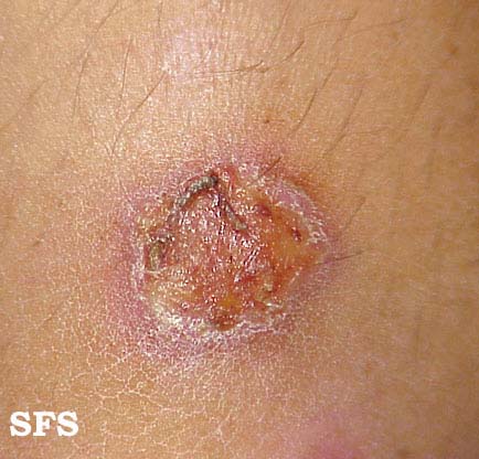 Herpes Pictures & Symptoms of Herpes Simplex