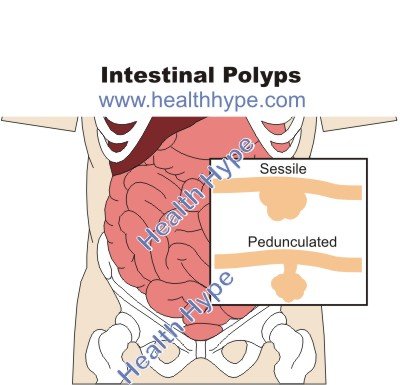 How are benign stomach tumors and polyps detected?