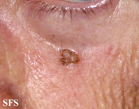 common warts on legs. is a flat, whitish, shiny,