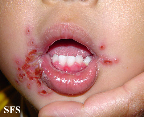 Remedy Of Cold Sores On Lips : Genital Herpes  A Life Sentence Of Misery_