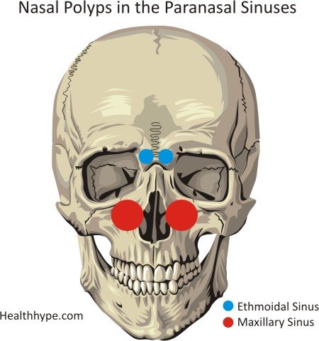 polyps in nose. A nasal polyp is an outgrowth