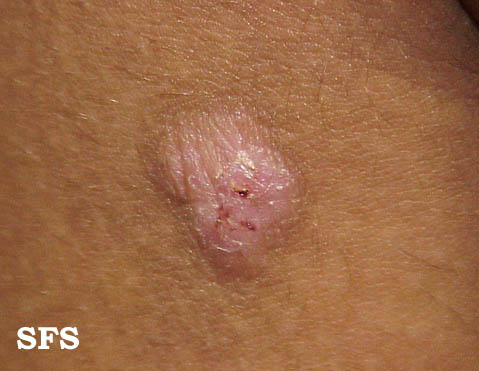 neurodermatitis4