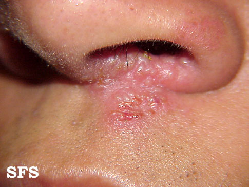 herpes under nose