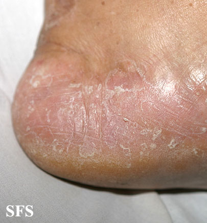 skin problems on foot #9