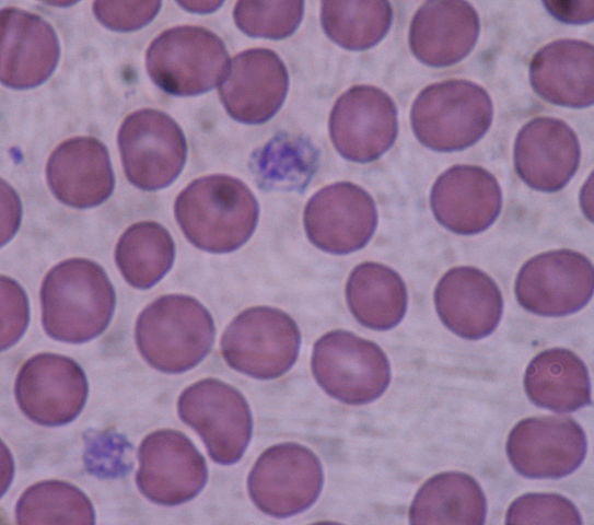 What causes elevated blood platelets?
