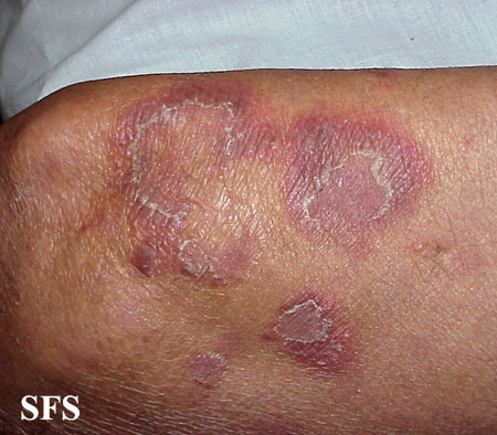 Types of Skin Diseases - Different conditions that affect ...