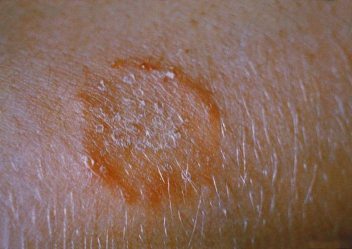Picture of a typical ringworm rash on the body from Wikimedia Commons