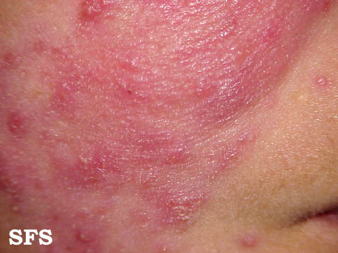 Skin rash and Stiff neck: Common Related Medical Conditions
