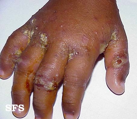 What are the symptoms of a scabies infection?