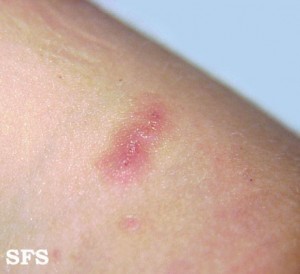 Itchy Skin Rash During Pregnancy – Pictures, Causes ...