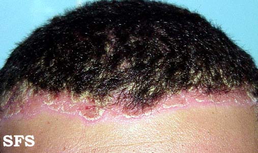 What causes itching scalp and hair loss?