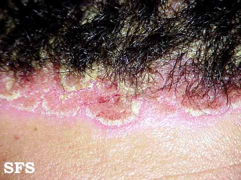 Scalp Psoriasis on Scalp Psoriasis And Similar Head Rashes   Pictures  Treatment