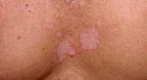 Seborrheic Dermatitis Pictures, Treatment (Face, Scalp ...
