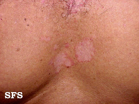 Breast rash - Mayo Clinic