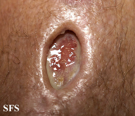 sporotrichosis ulcer
