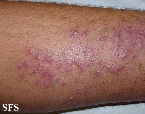 diabetic skin rashes pictures #10