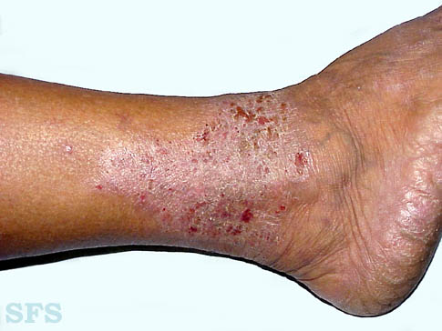 Corticosteroid creams for psoriasis
