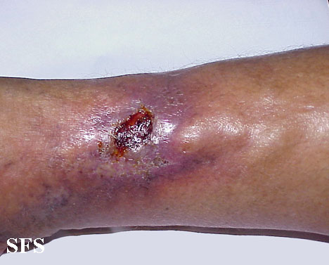 What Is Eczema Understanding The Causes Symptoms And Treatments .